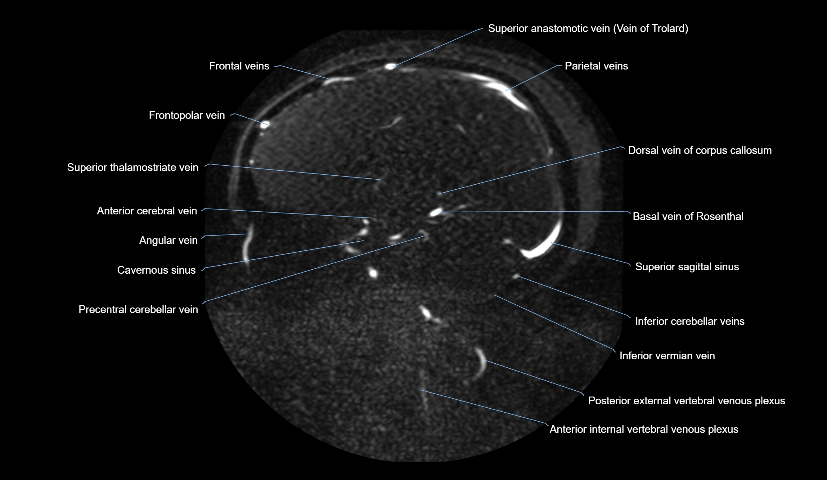 MRV brain sagittal anatomy 3T MRI labelledimages -00048.webp